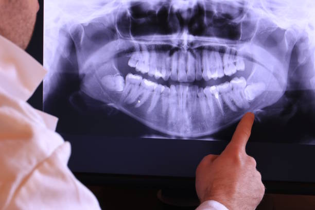 Best Emergency Wisdom Tooth Extraction in Kentfield, CA