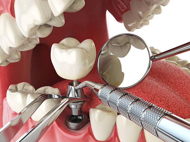 Best Emergency Root Canal Therapy in Kentfield, CA